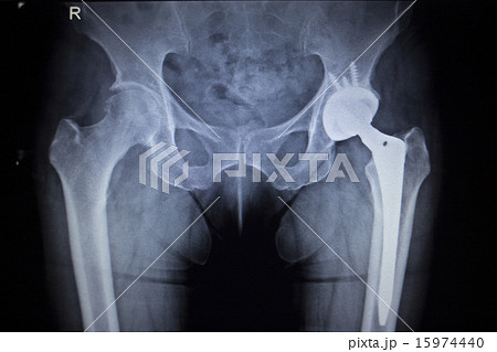 X-ray scan  image of hip joint replacement implant 15974440