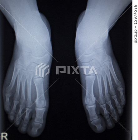 X-ray scan of foot injury anterior posterior AP 15974536