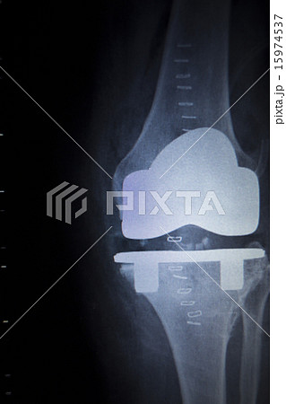X-ray scan of knee meniscus implant prosthetics 15974537
