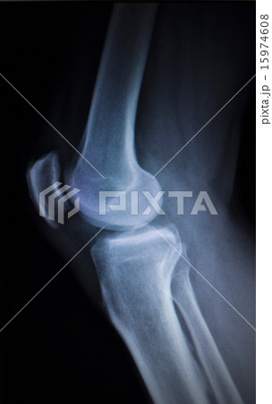 X-ray scan of painful knee meniscus leg injury X-ray scan of painful knee meniscus leg injury 15974608