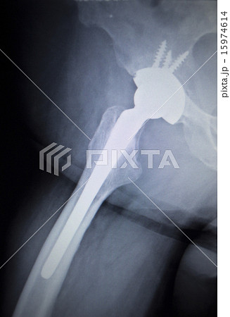 X-ray scan  image of hip joint replacement implant 15974614
