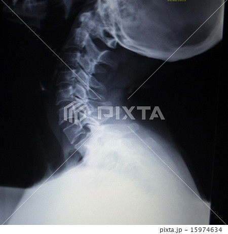 X-ray orthopedics Traumatology scan of neck injury X-ray orthopedics Traumatology scan of neck injury 15974634