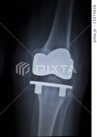X-ray scan of knee meniscus implant prosthetics X-ray scan of knee meniscus implant prosthetics 15974638
