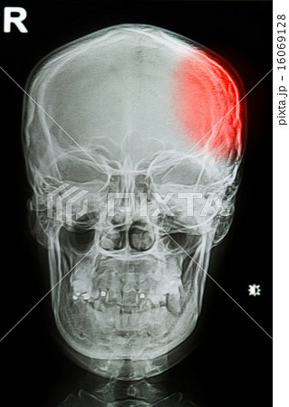 x-ray image of the painful or injury skull x-ray image of the painful or injury skull 16069128