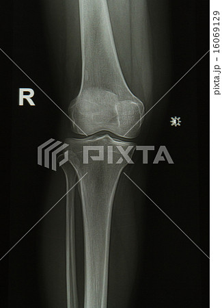 knee joint x-rays image knee joint x-rays image 16069129