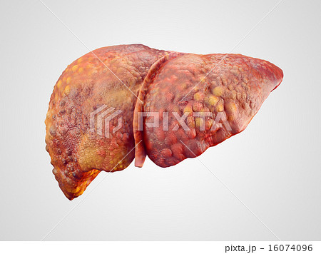 Realistic illustration of cirrhosis of human liver 16074096