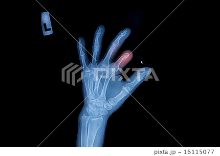 X-ray of trauma hand and finger X-ray of trauma hand and finger 16115077
