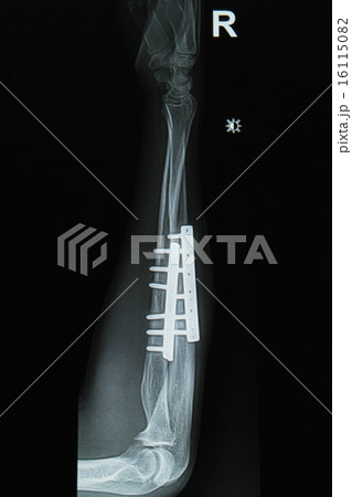 fracture forearm x-rays image  16115082