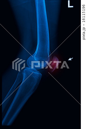 trauma knee joint x-rays image vertical 16115196