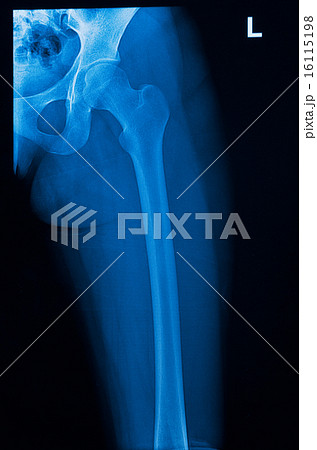 Hip x-ray of human 16115198