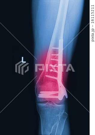 broken human thigh x-rays image with implant  16115211
