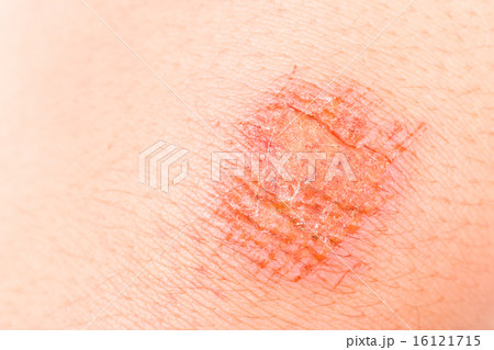 Close up on painful bruise wound on the knee Close up on painful bruise wound on the knee 16121715
