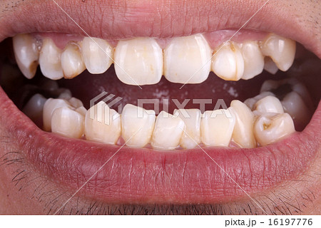 Mouth with crooked teeth Mouth with crooked teeth 16197776