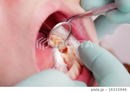 Dental procedure, tooth drilling Dental procedure, tooth drilling 16333946