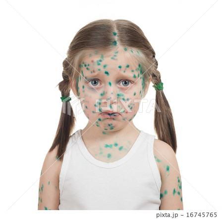 sick child. chickenpox 16745765