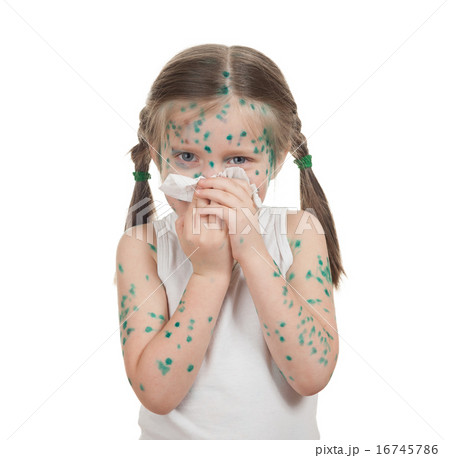 sick child. chickenpox 16745786