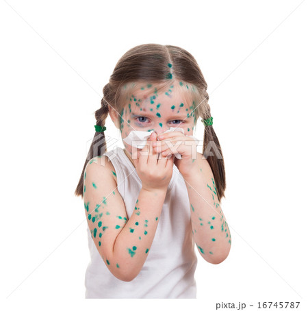 acnes on child. chickenpox 16745787