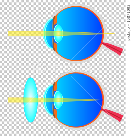 Cross sectional view of hyperopia 16871092