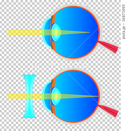Cross sectional view of myopia 16871093