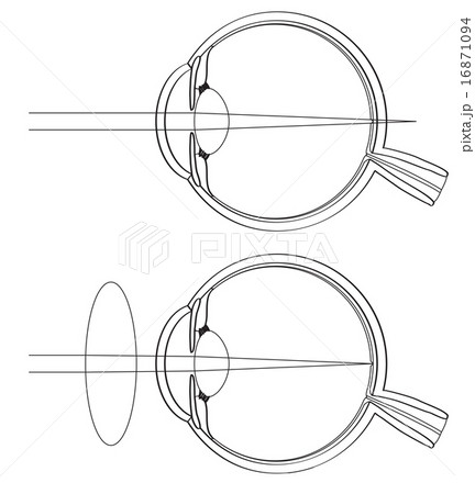 遠視の断面図 16871094