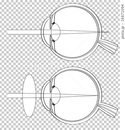 遠視の断面図 16871094