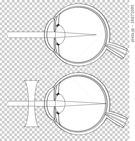 Cross sectional view of myopia 16871095