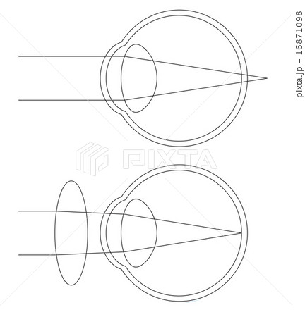 遠視の断面図 16871098