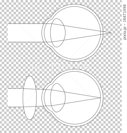 遠視の断面図 16871098