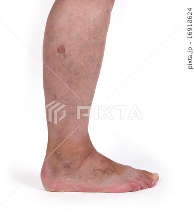Old woman with varicose veins 16918624
