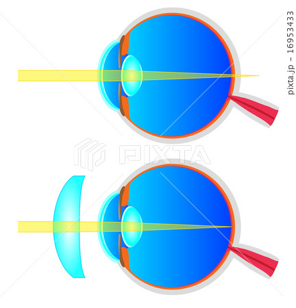 遠視の断面図 16953433