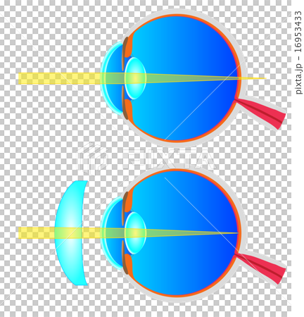 遠視の断面図 16953433