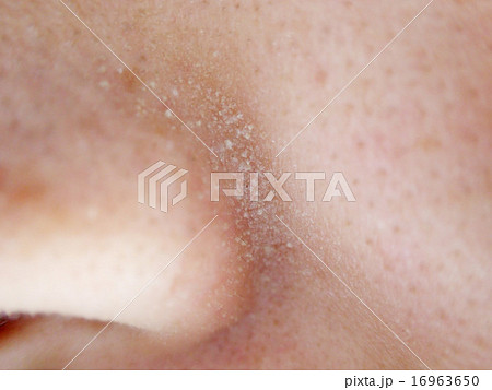 角栓拡大肌の写真素材