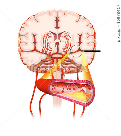 アテローム血栓性脳梗塞のイラスト素材
