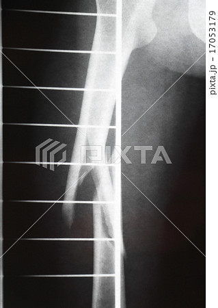 大腿骨骨折のレントゲン写真 17053179