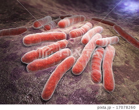 Bacterial infection tuberculosis 17078260