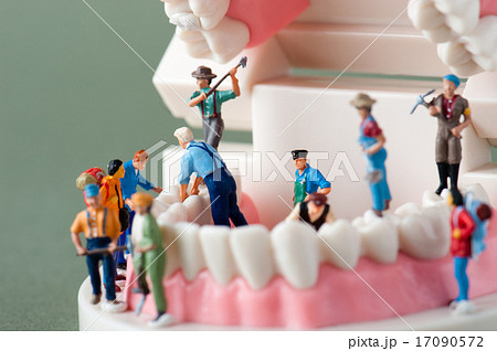 歯の模型とインプラントのイメージ 歯の模型とインプラントのイメージ 17090572