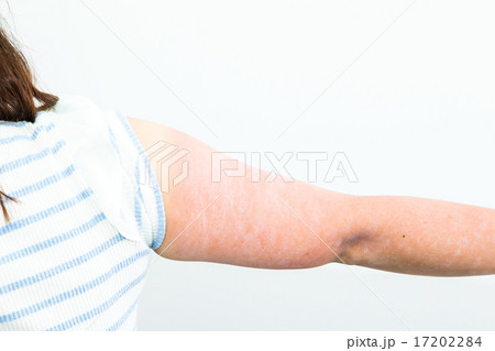 女性 日本人 日焼け サンタン 紫外線 腕 油断 日焼けした腕 夏に注意 真夏 炎症 皮膚の写真素材