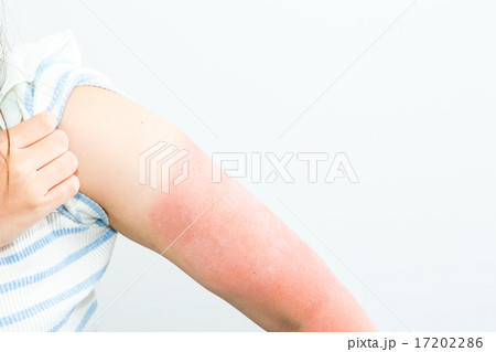 女性 日本人 日焼け サンタン 紫外線 腕 油断 日焼けした腕 夏に注意 真夏 炎症 皮膚 女性 日本人 日焼け サンタン 紫外線 腕 油断 日焼けした腕 夏に注意 真夏 炎症 皮膚 17202286