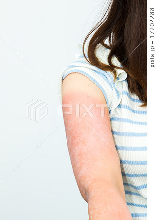 女性 日本人 日焼け サンタン 紫外線 腕 油断 日焼けした腕 夏に注意 真夏 炎症 皮膚 女性 日本人 日焼け サンタン 紫外線 腕 油断 日焼けした腕 夏に注意 真夏 炎症 皮膚 17202288