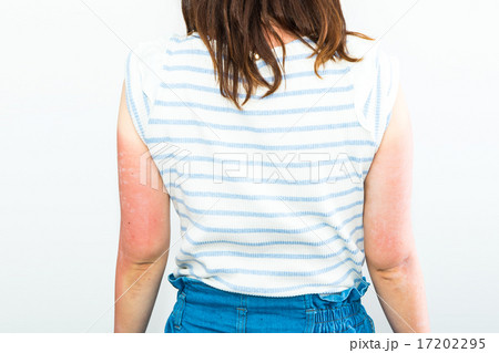 女性　日本人　日焼け　サンタン　紫外線　腕　油断　日焼けした腕　夏に注意　真夏　炎症　皮膚 17202295