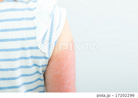 女性 日本人 日焼け サンタン 紫外線 腕 油断 日焼けした腕 夏に注意 真夏 炎症 皮膚 女性 日本人 日焼け サンタン 紫外線 腕 油断 日焼けした腕 夏に注意 真夏 炎症 皮膚 17202296