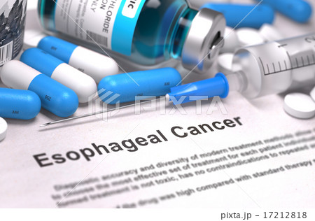 Esophageal Cancer Diagnosis. Medical Concept. Esophageal Cancer Diagnosis. Medical Concept. 17212818
