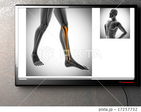human bones radiography scan image 17257732