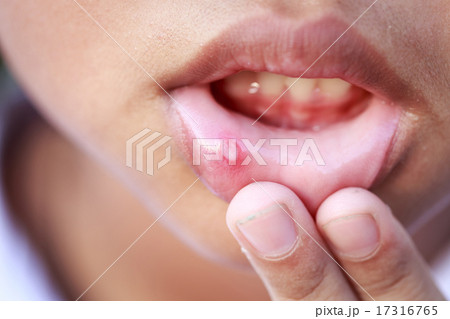 Children with aphtha on lip 17316765