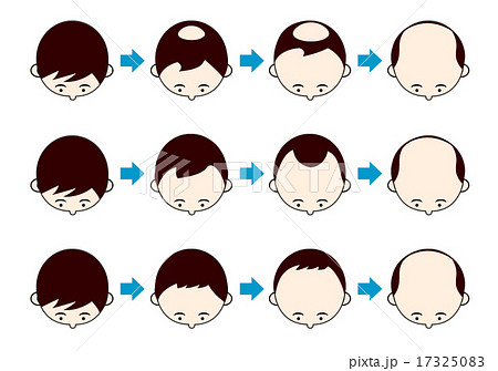 AGAの進行タイプ 17325083