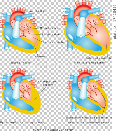 Diseases of the Heart Muscle 17420433