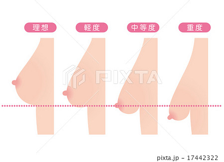 乳房下垂　美容 17442322