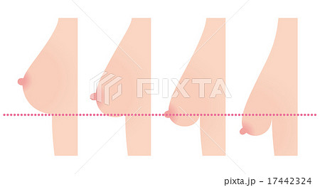 乳房下垂　美容 17442324