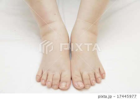 ひどく浮腫んだ足 17445977