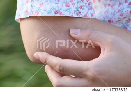 蚊に刺された後の湿疹 17533352